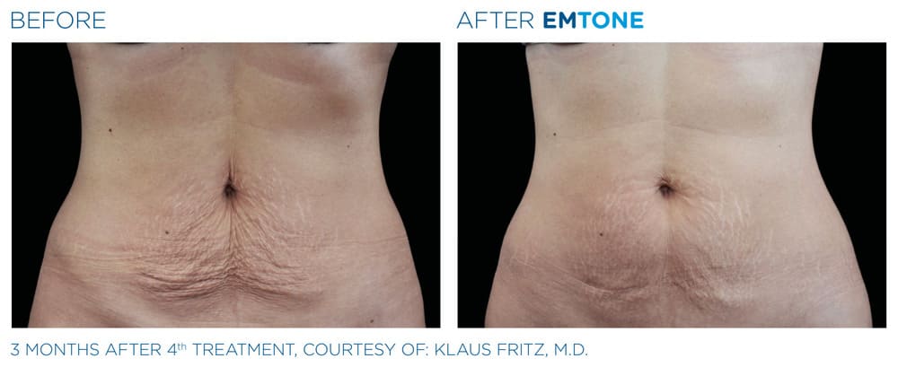 A before-and-after image comparing the skin texture on a person's midsection and abdomen.