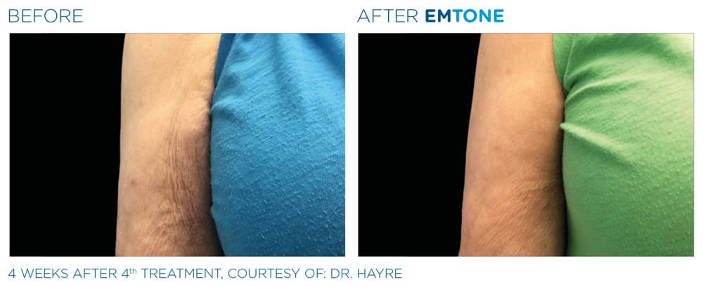 A before-and-after image comparing the skin texture on a person's upper arm.