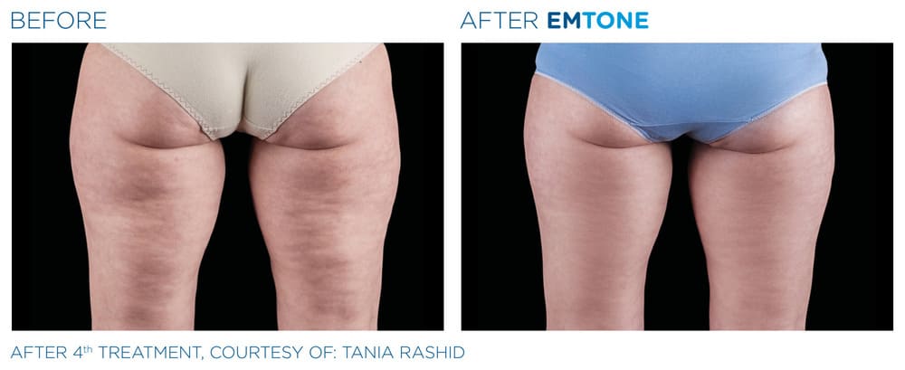 A before-and-after image comparing the back of a person's upper thighs and buttocks.