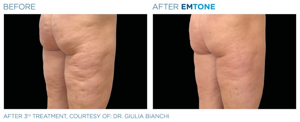 A before-and-after image comparing the upper thighs and buttocks from a side/rear view.