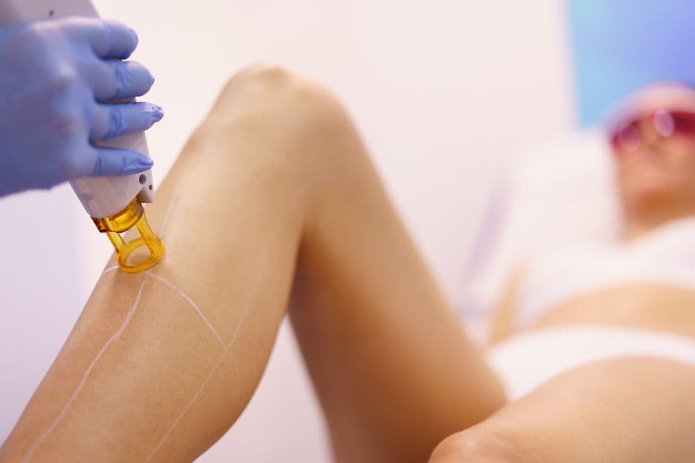 A client's leg receiving a laser hair removal treatment.
